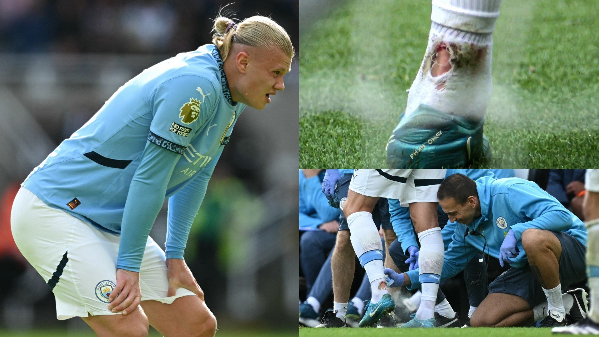 Erling Haaland Left Bloodied With Torn Sock After Man City Hitman erling-haaland-left-bloodied-with-torn-sock-after-man-city-hitman